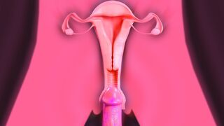 (X-ray) How to impregnate Tifa